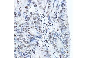Immunohistochemistry of paraffin-embedded human colon carcinoma using Twist Rabbit pAb (ABIN6133951, ABIN6149713, ABIN6149716 and ABIN6220170) at dilution of 1:200 (40x lens). (TWIST1 antibody  (AA 1-100))