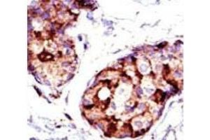 IHC analysis of FFPE human breast carcinoma tissue stained with the TSG101 antibody. (TSG101 antibody  (AA 1-30))