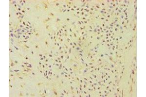 Immunohistochemistry of paraffin-embedded human breast cancer using ABIN7144871 at dilution of 1:100 (ATP5J antibody  (AA 1-108))