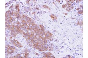 IHC-P Image MPP3 antibody detects MPP3 protein at cytosol on human breast cancer by immunohistochemical analysis.
