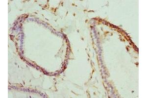 Immunohistochemistry of paraffin-embedded human breast cancer using ABIN7145330 at dilution of 1:100 (BNIP2 antibody  (AA 125-280))