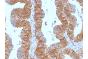 Immunohistochemistry (IHC) image for anti-Epithelial Cell Adhesion Molecule (EPCAM) (AA 77-202), (Extracellular Domain) antibody (ABIN6939979)
