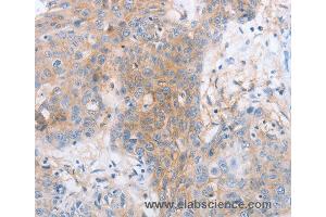 Immunohistochemistry of Human cervical cancer using LILRB2 Polyclonal Antibody at dilution of 1:30 (LILRB2 antibody)