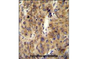 ACF Antibody immunohistochemistry analysis in formalin fixed and paraffin embedded human hepatocarcinoma followed by peroxidase conjugation of the secondary antibody and DAB staining.