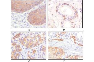 Immunohistochemical analysis of paraffin-embedded human esophagus epithelium (A), salivary gland basal cell (B), lung squamous cell carcinoma (C), endometrium admosquamous carcinoma (D), showing cytoplasmic and membrane localization using CK5 mouse mAb with DAB staining. (Cytokeratin 5 antibody)
