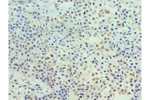 Immunohistochemistry of paraffin-embedded human breast cancer using ABIN7172113 at dilution of 1:100 (TK1 antibody  (AA 1-234))