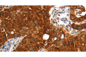 Immunohistochemistry of paraffin-embedded Human lung cancer using VWA5A Polyclonal Antibody at dilution of 1:60