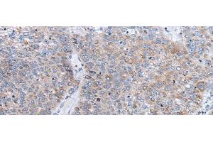 Immunohistochemistry of paraffin-embedded Human liver cancer tissue using ENPP2 Polyclonal Antibody at dilution of 1:50(x200) (ENPP2 antibody)