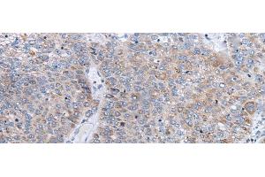 Immunohistochemistry of paraffin-embedded Human liver cancer tissue using ENPP2 Polyclonal Antibody at dilution of 1:50(x200)