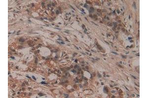 DAB staining on IHC-P; Samples: Human Pancreatic cancer Tissue (LIFR antibody  (AA 45-184))
