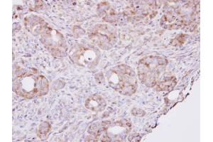 IHC-P Image Immunohistochemical analysis of paraffin-embedded NCIN87 xenograft , using RPL8, antibody at 1:100 dilution. (RPL8 antibody)