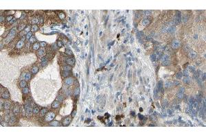 ABIN6278914 at 1/100 staining Human prostate tissue by IHC-P. (KRT23 antibody  (N-Term))