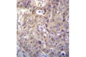 Immunohistochemistry analysis in formalin fixed and paraffin embedded human breast carcinoma recated with HIPK1 Antibody (C-term) followed by peroxidase conjugation of the secondary antibody and DAB staining. (HIPK1 antibody  (C-Term))