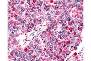 Anti-BAI2 antibody IHC of human Lung, Non-Small Cell Carcinoma.