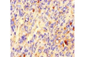 Immunohistochemistry of paraffin-embedded human melanoma using ABIN7148160 at dilution of 1:100 (CCDC84 antibody  (AA 1-200))