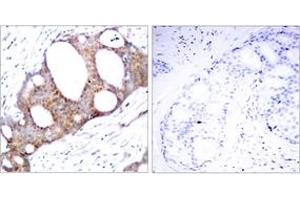 Immunohistochemistry analysis of paraffin-embedded human breast carcinoma, using GSK3 alpha (Phospho-Ser21) Antibody.