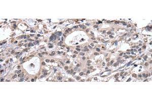 Immunohistochemistry of paraffin-embedded Human gastric cancer tissue using TRIM27 Polyclonal Antibody at dilution of 1:65(x200)