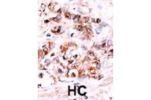 Formalin-fixed and paraffin-embedded human hepatocellular carcinoma tissue reacted with DUSP15 polyclonal antibody  , which was peroxidase-conjugated to the secondary antibody, followed by AEC staining. (DUSP15 antibody  (N-Term))