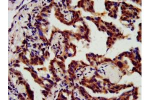 IHC image of ABIN7147529 diluted at 1:800 and staining in paraffin-embedded human lung cancer performed on a Leica BondTM system. (CHMP5 antibody  (AA 1-219))