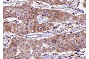 ABIN6274061 at 1/100 staining human liver carcinoma tissue sections by IHC-P. (Dynamin 1-Like antibody  (pSer637))