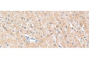 Immunohistochemistry of paraffin-embedded Human liver cancer tissue using MLKL Polyclonal Antibody at dilution of 1:85(x200) (MLKL antibody)