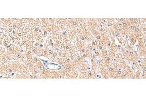 Immunohistochemistry of paraffin-embedded Human liver cancer tissue using MLKL Polyclonal Antibody at dilution of 1:85(x200) (MLKL antibody)