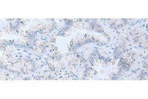 Immunohistochemistry of paraffin-embedded Human lung cancer tissue using ATP6V1C1 Polyclonal Antibody at dilution of 1:100(x200) (ATP6V1C1 antibody)