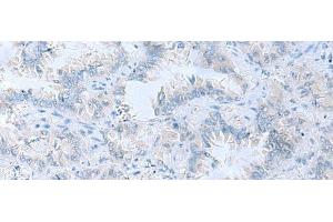 Immunohistochemistry of paraffin-embedded Human lung cancer tissue using ATP6V1C1 Polyclonal Antibody at dilution of 1:100(x200) (ATP6V1C1 antibody)