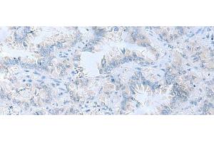 Immunohistochemistry of paraffin-embedded Human lung cancer tissue using ATP6V1C1 Polyclonal Antibody at dilution of 1:100(x200)