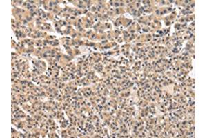 The image on the left is immunohistochemistry of paraffin-embedded Human liver cancer tissue using ABIN7131587(VPS41 Antibody) at dilution 1/20, on the right is treated with fusion protein. (VPS41 antibody)