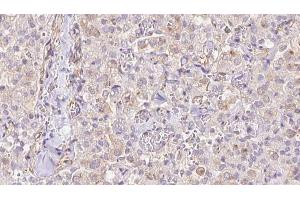 ABIN6273331 at 1/100 staining Human thyroid cancer tissue by IHC-P. (TIMM9 antibody  (C-Term))