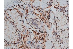 ABIN6267444 at 1/50 staining human colon cancer tissue sections by IHC-P. (GATA3 antibody  (pSer308))