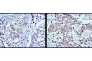 Immunohistochemical analysis of paraffin-embedded human lung cancer (left) and breast cancer (right) using RTN3 antibody with DAB staining. (Reticulon 3 antibody)