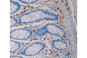 IHC-P analysis of Human Rectum Cancer Tissue, with DAB staining. (TPSAB1 antibody  (AA 161-262))
