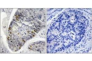 Immunohistochemistry analysis of paraffin-embedded human colon carcinoma, using Histone H1 (Phospho-Thr17) Antibody. (Histone H1 antibody  (pSer17))