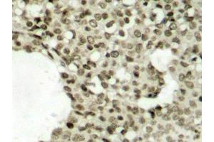 Immunohistochemistry of paraffin-embedded Human breast carcinoma tissue, using Phospho-STAT1(S727) Polyclonal Antibody (STAT1 antibody  (pSer727))