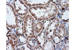 Immunohistochemical staining of paraffin-embedded Adenocarcinoma of ovary tissue using anti-LIPG mouse monoclonal antibody. (LIPG antibody)
