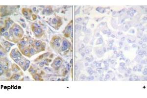Immunohistochemical analysis of paraffin-embedded human breast carcinoma tissue using ITGB4 polyclonal antibody . (Integrin beta 4 antibody)