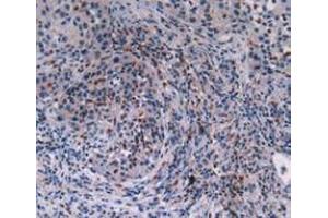 IHC-P analysis of Human Lung Cancer Tissue, with DAB staining. (MAT2A antibody  (AA 176-395))