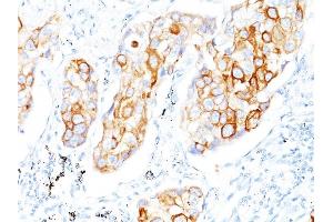 Formalin-fixed, paraffin-embedded human Lung SCC stained with Cytokeratin 7 Mouse Monoclonal Antibody (OV-TL12/30) (Cytokeratin 7 antibody)