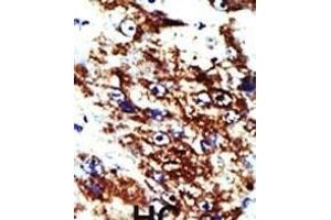 Formalin-fixed and paraffin-embedded human cancer tissue reacted with the primary antibody, which was peroxidase-conjugated to the secondary antibody, followed by DAB staining. (FDPS antibody  (N-Term))