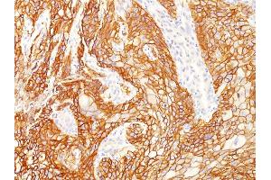 Formalin-fixed, paraffin-embedded human Lung SqCC stained with EGFR Mouse Monoclonal Antibody (GFR/2341). (EGFR antibody  (AA 344-492))