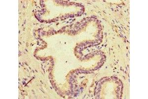Immunohistochemistry of paraffin-embedded human prostate cancer using ABIN7160306 at dilution of 1:100 (Multicilin antibody  (AA 3-110))