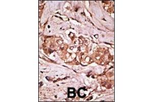 Formalin-fixed and paraffin-embedded human cancer tissue reacted with the primary antibody, which was peroxidase-conjugated to the secondary antibody, followed by AEC staining. (LRRK2 antibody  (AA 931-962))