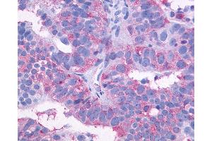 Anti-SIPR3 / EDG3 / S1P3 antibody IHC of human Ovary, Carcinoma. (S1PR3 antibody  (C-Term))