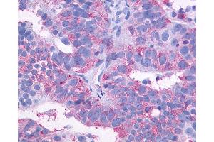 Anti-SIPR3 / EDG3 / S1P3 antibody IHC of human Ovary, Carcinoma.