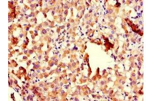 Immunohistochemistry of paraffin-embedded human lung cancer using ABIN7151005 at dilution of 1:100 (CHFR antibody  (AA 141-422))