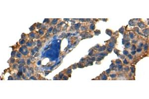 Immunohistochemistry of paraffin-embedded Human ovarian cancer tissue using DNAJC2 Polyclonal Antibody at dilution of 1:40(x200) (DNAJC2 antibody)