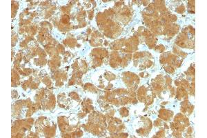 Formalin-fixed, paraffin-embedded human Thyroid Carcinoma stained with TSHRA Mouse Monoclonal Antibody (TSHRA/1402). (TSH receptor antibody)