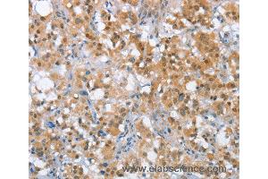 Immunohistochemistry of Human thyroid cancer using MLH1 Polyclonal Antibody at dilution of 1:65 (MLH1 antibody)